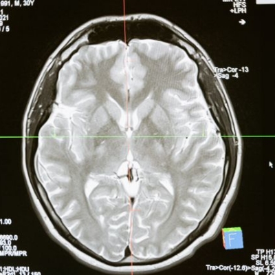 Brain scan showing amygdala changes from mindfulness meditation for anxiety